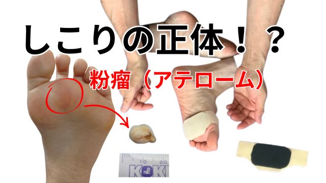 足裏にできる粉瘤（アテローム）とは？特徴 原因 対処法