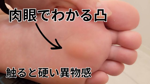 肉眼でもわかる凸、粉瘤画像と治し方のアドバイス|症例「足裏のしこりが痛い」１０代女性