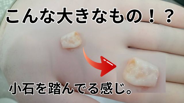 こんな大きな異物が、粉瘤画像と治し方のアドバイス|症例「足裏のしこりが痛い」１０代女性