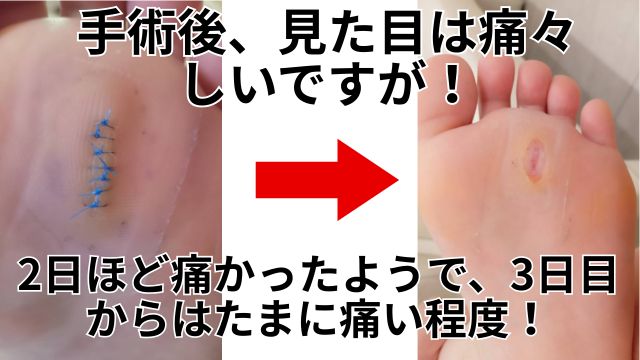 手術後、痛々しいけど痛くない、粉瘤画像と治し方のアドバイス|症例「足裏のしこりが痛い」１０代女性