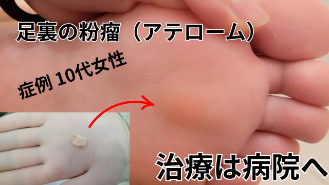 粉瘤画像と治し方のアドバイス|症例「足裏のしこりが痛い」１０代女性