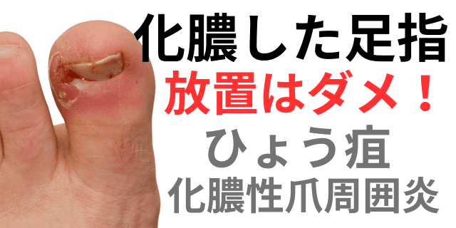 ひょう疽で膿んで痛い症状は何科に行けばよいか？放置は絶対ダメ！