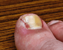 ひょう疽、化膿性爪周囲炎、膿んだ爪