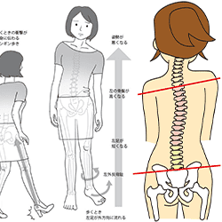 骨盤の歪み