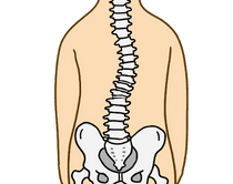 側弯症（腰椎）