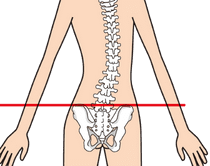 側弯症（腰椎）