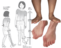 側弯症は足の歪みから起こる場合がある？